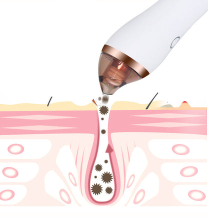 Blackhead Remover