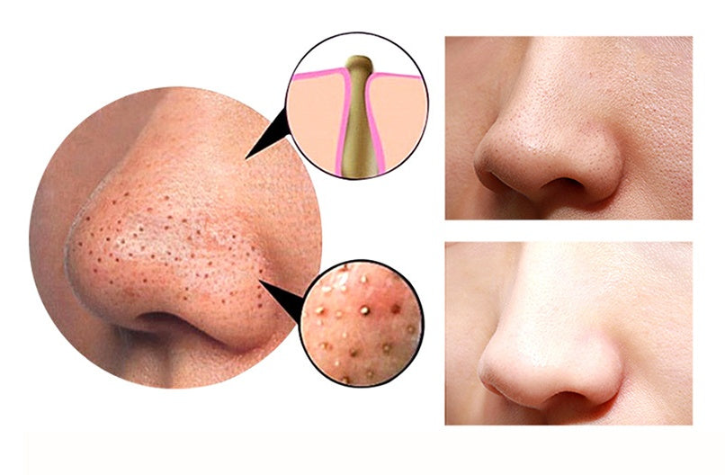 Blackhead Remover